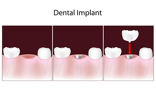 dental implants in erath